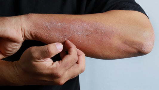 Eczema, Asthma, and Allergies - Managing the Atopic March from the Inside Out